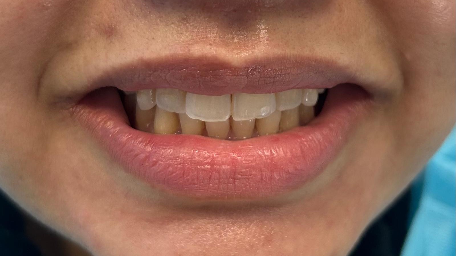 Before veneers
