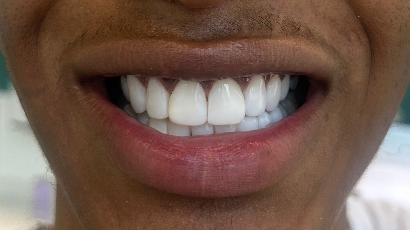After composite bonding