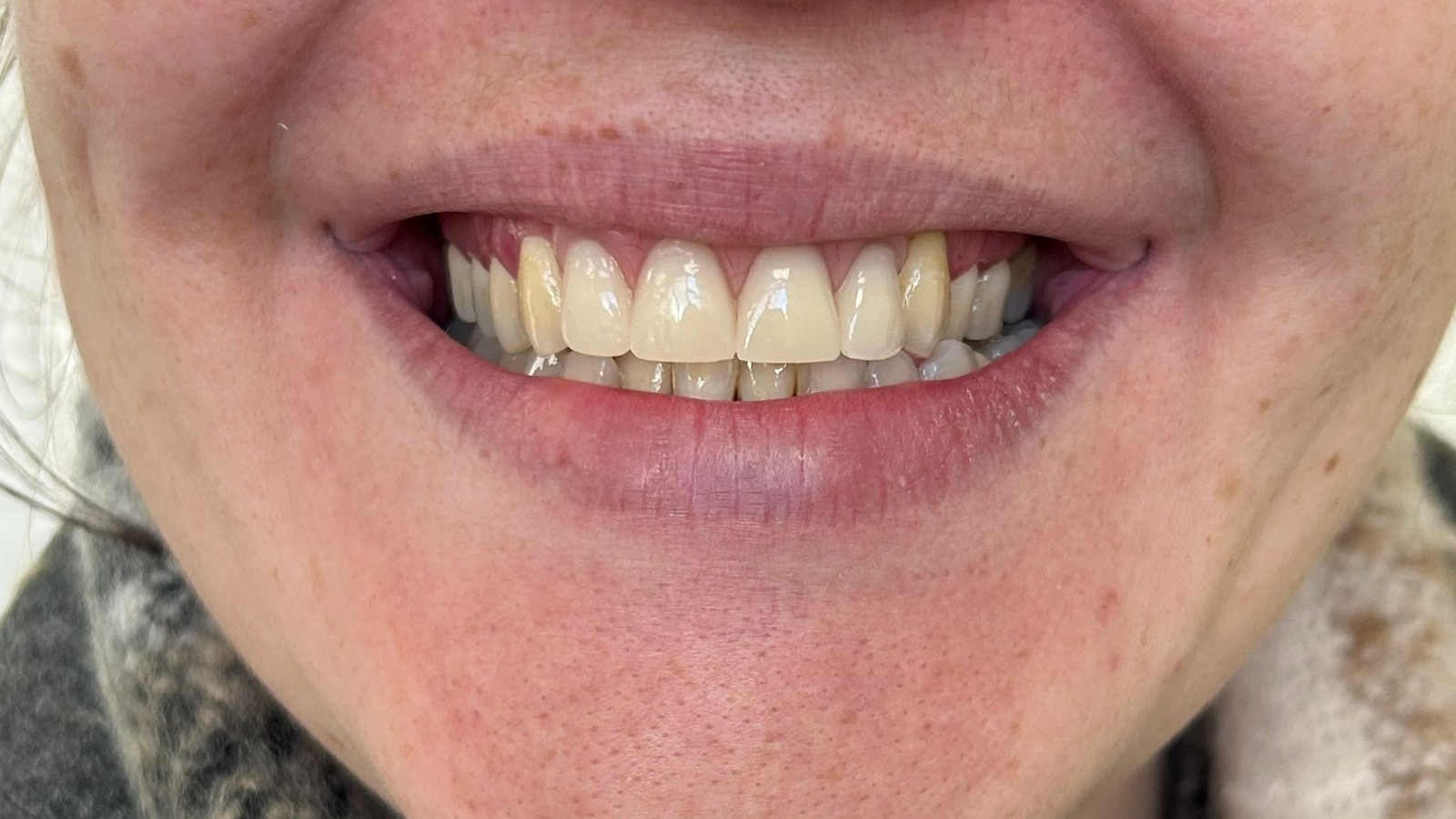 After composite bonding