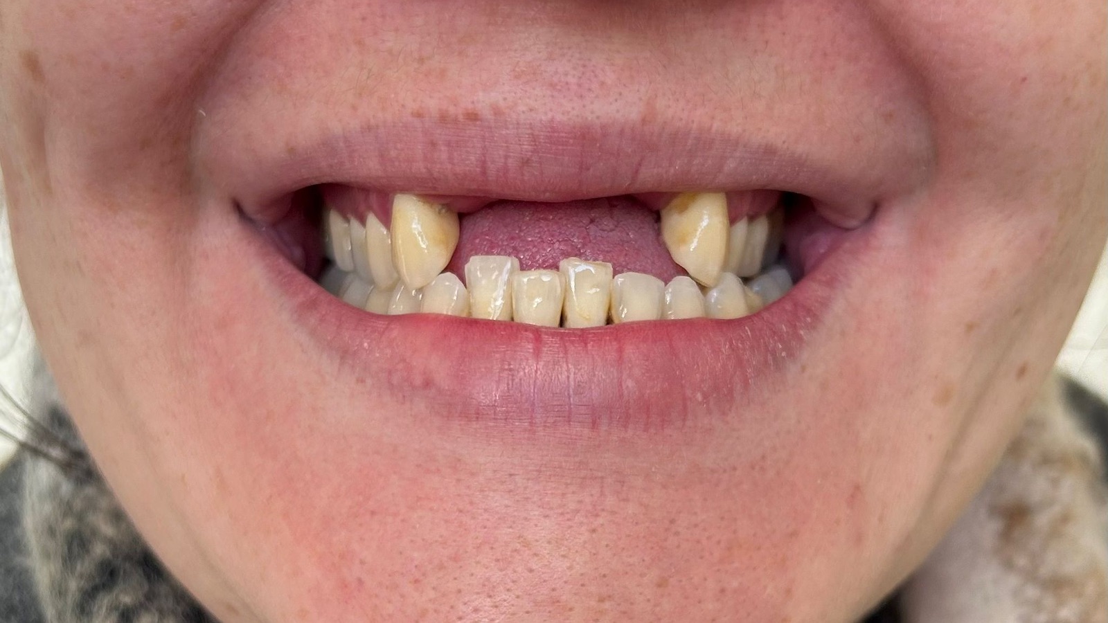 Before composite bonding