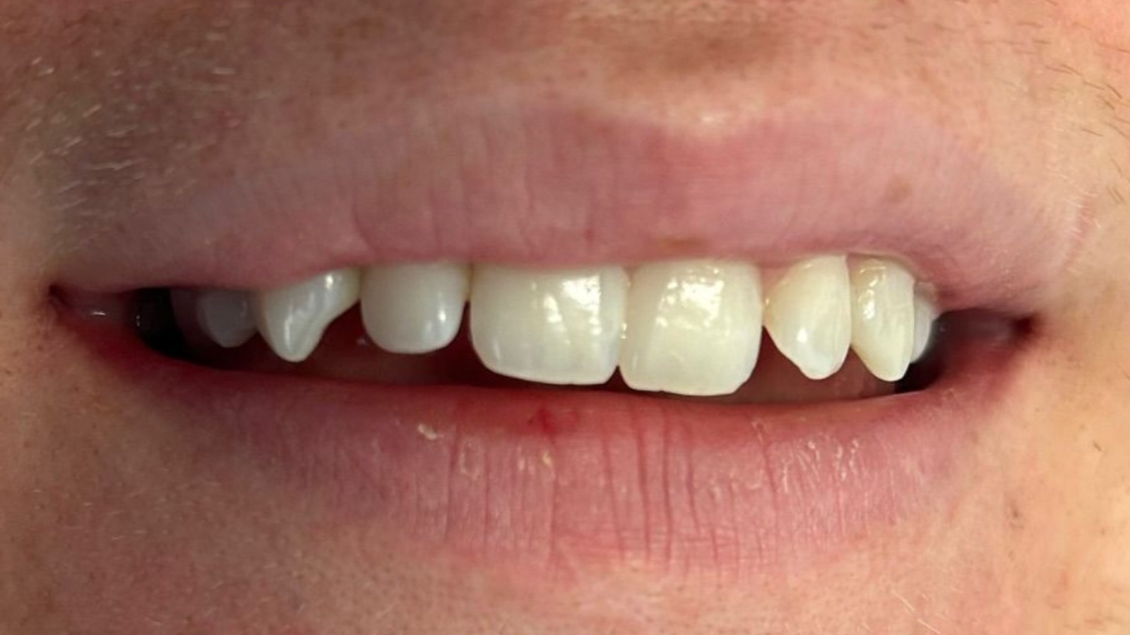 Before composite bonding