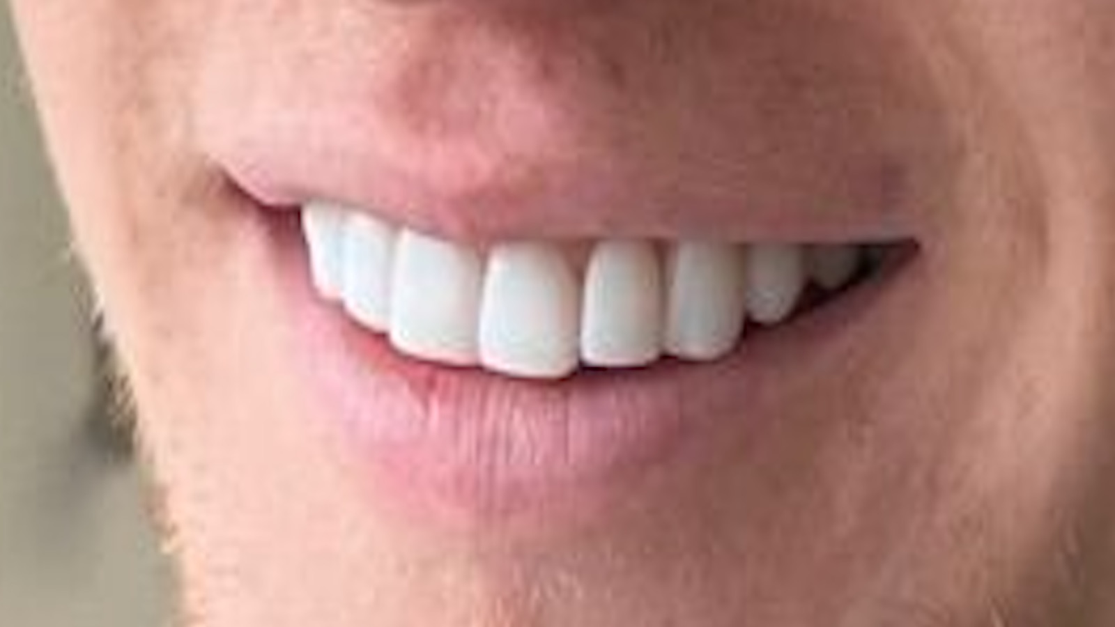 After composite bonding