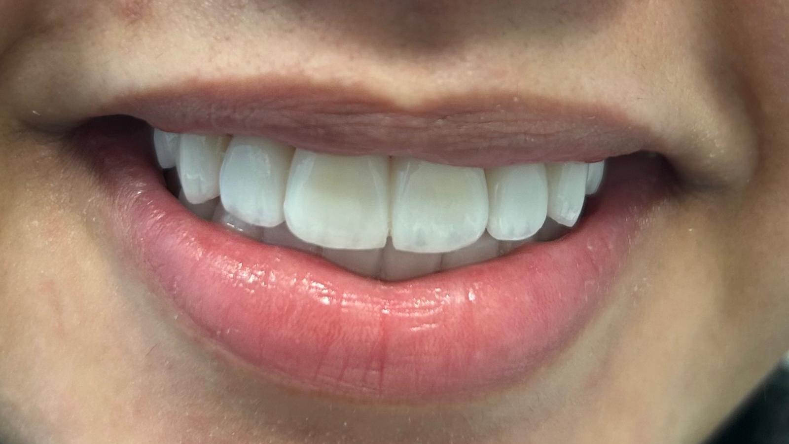 After veneers