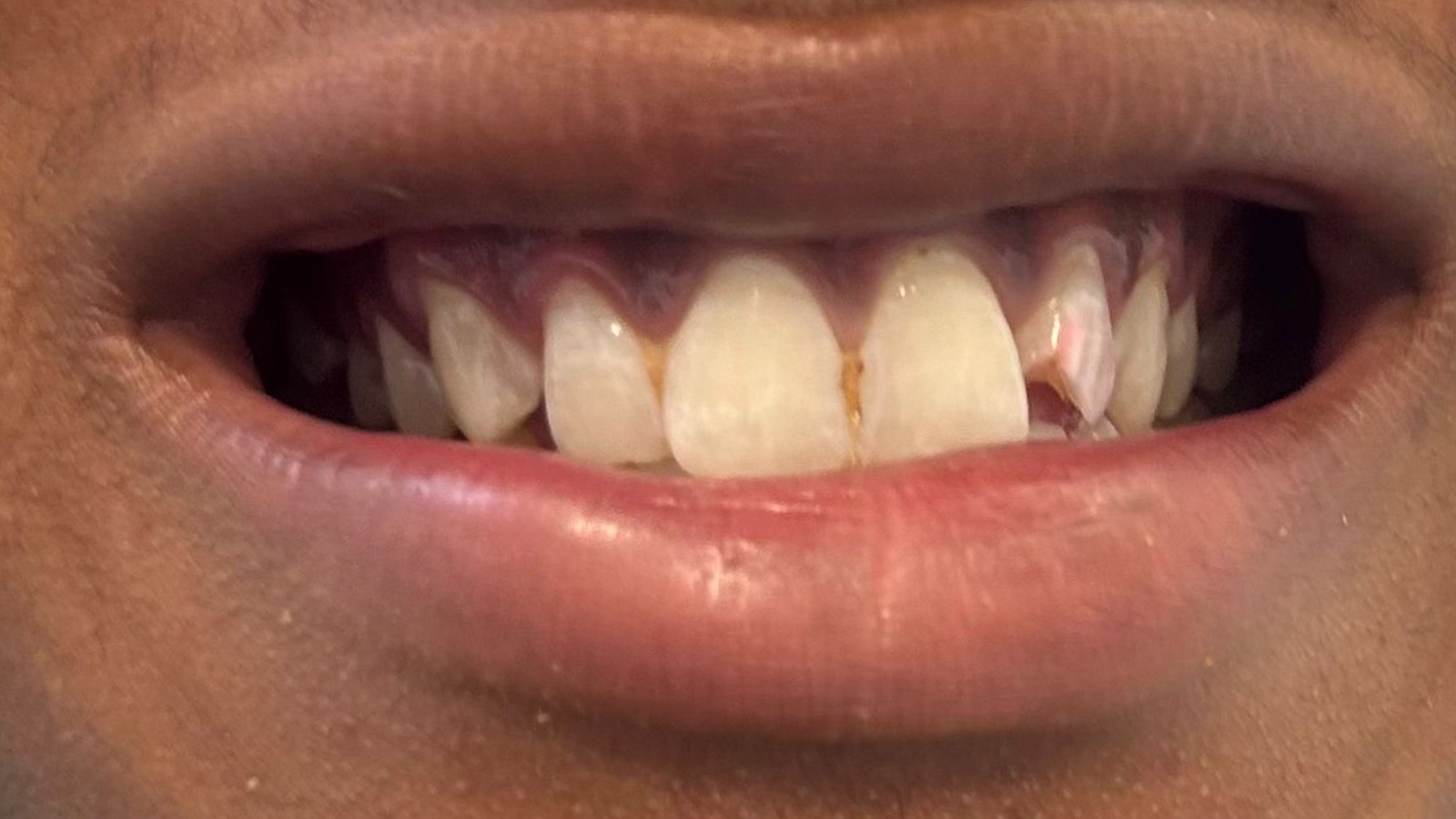 Before composite bonding